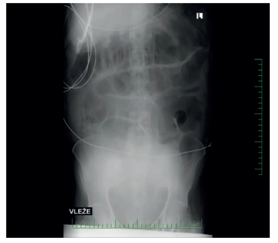RTG břicha druhý den po přijetí<br>
Fig. 2: Abdominal X-ray – second day after admission