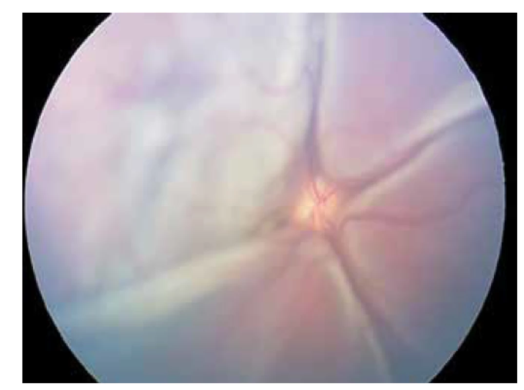 Snímek z retinální kamery – exsudativní amoce od papily
již v celém rozsahu