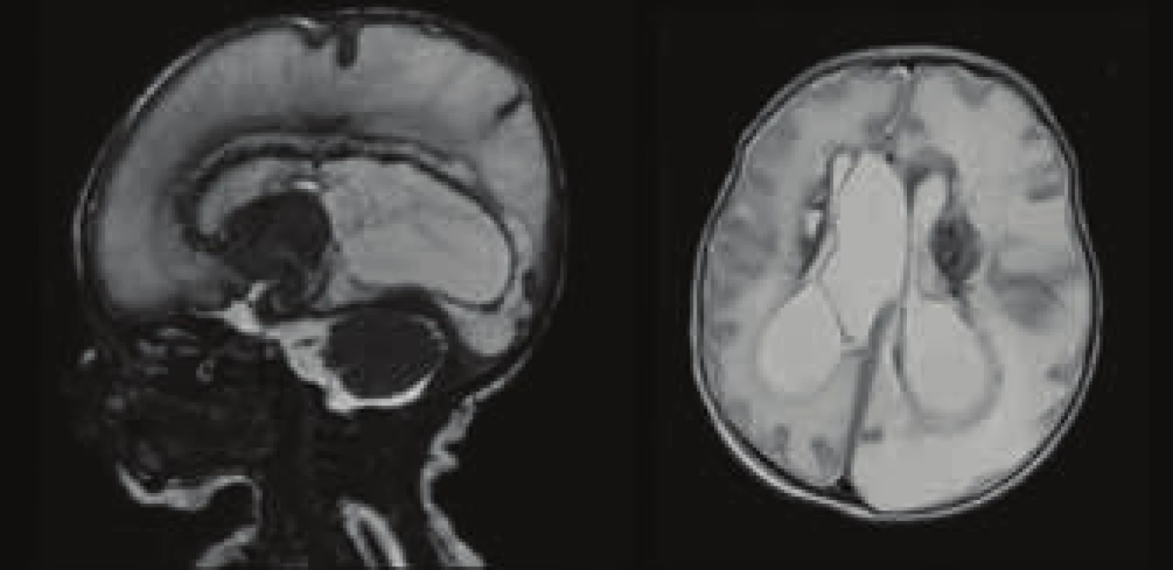 MRI vyšetření CNS – rozsáhlé ischemicko-pseudocystické
změny obou mozkových hemisfér, slupkovitý parenchym vlevo
a oboustranně zjevné periventrikulární krvácení.