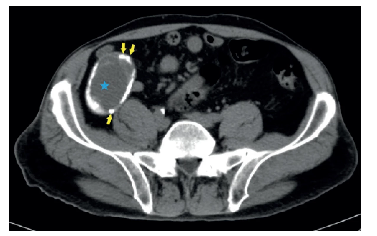 CT obraz mukokély apendixu – axiální rovina<br>
CT břicha s podáním kontrastní látky intravenózně, porto-
-venózní fáze, stejný pacient. V oblasti céka je patrný tubulární
útvar s hypodenzním obsahem (modrá hvězda). Jeho stěna
je nepravidelně kalcifikovaná (žluté šipky). Klinika radiologie
a nukleární medicíny FN Brno a LF MU.<br>
Fig. 3: CT (computed tomography) scan of appendiceal
mucocele – axial plane<br>
CT of the abdomen with intravenous contrast, porto-venous
phase, the same patient. A tubular formation with hypodense
content is present in the area of the cecum (blue star). Its wall
is irregularly calcified (yellow arrows). Department of Radiology
and Nuclear Medicine, University Hospital Brno, Faculty
of Medicine, Masaryk University.