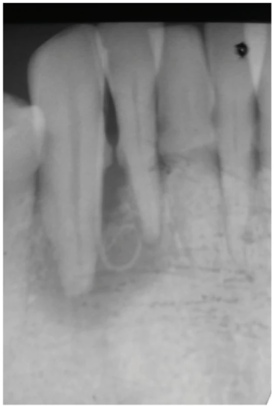 Periapikální snímek zubu 43<br>
Fig. 1
Periapical radiograph
of tooth 43