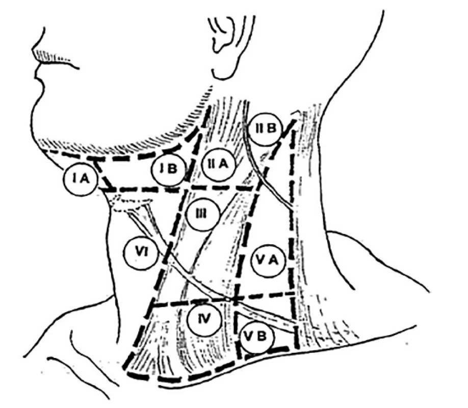 Krční lymfatické kompartmenty I–VI, chybí oblast VII
v jugulu a mediastinu [12]