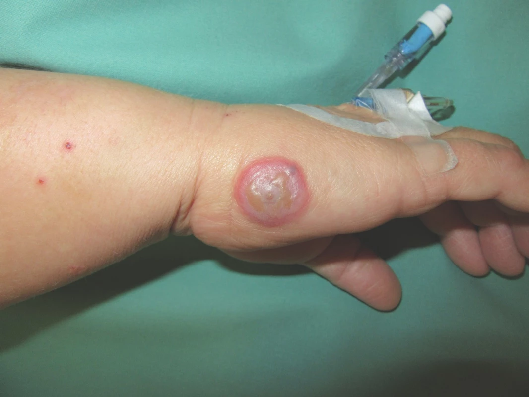 Klinický obraz – dojičský hrbol na pravé ruce