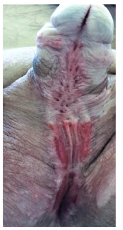 Uretrální ploténka šest měsíců
po dermatologické léčbě<br>
Fig. 4. Urethral plate six months
after dermatological treatment