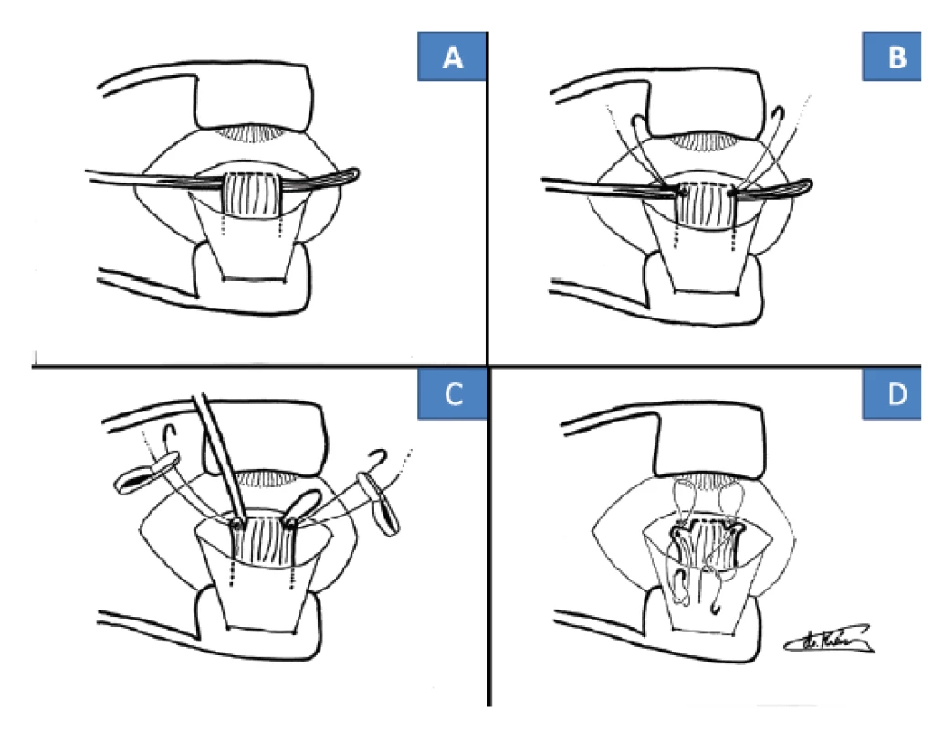 Operační technika cul-de-sac: zavedení Davielovy lžičky
(A), založení stehů z Ethibondu 5-0 (B), odstřižení svalu se stehy
těsně u skléry (C), zpětné prošití do původního úponu (D)