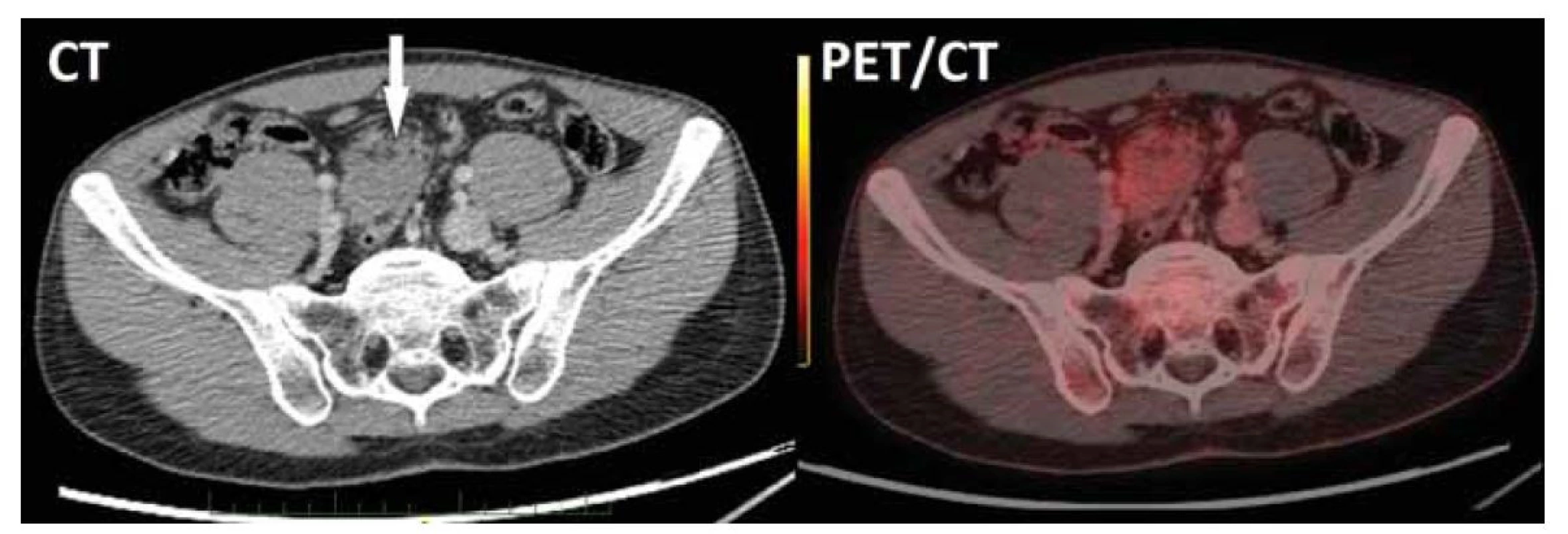 CT vyšetření břicha s nálezem měkkotkáňového útvaru o velikosti 43 x 42 x 39 mm v mezenteriu (šipka) obsahujícího
drobné tukové podíly. PET/CT rekonstrukce potvrdila v mezikličkové lokalizaci nepravidelný solidní útvar s okrajově patrným
fokusem lehce zvýšené akumulace FDG, bez známek lymfadenopatie či eventuální diseminace.<br>
Fig. 1. Abdominal CT scan showed 43 x 42 x 39 mm mesenteric soft tissue lesion containing small adipose areas. PET/CT reconstruction
confirmed irregular solid interloop lesion with slightly higher FDG uptake in marginal area and no signs of lymphadenopathy
or dissemination.