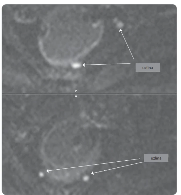  Detekce uzlin při MR vyšetření na DWI sekvenci. Všechny zachycené uzliny (cca
5–6 v perirektálním prostoru) neměly ani v T1w a T2w ani v DWI znaky patologických
uzlin v okolí nádoru (malá velikost do 5 mm, tvar spíše oválný, k okrajům se vzhledem
k velikosti nelze exaktně vyjádřit).
DWI – difuzí vážený obraz, MR – magnetická rezonance, T1w – T1 vážený obraz,
T2w – T2 vážený obraz 