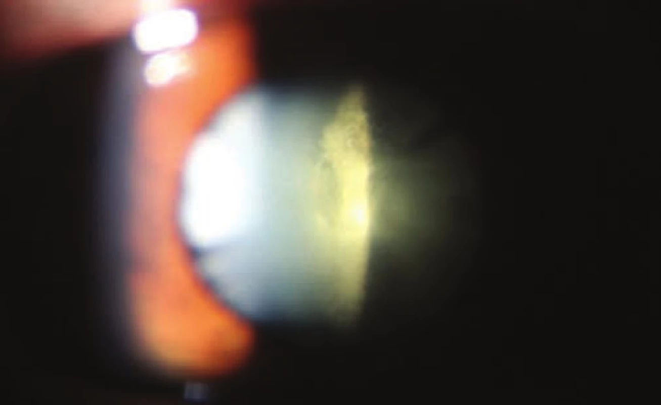 Image of 3rd grade posterior subcapsular cataract according
to Crews
