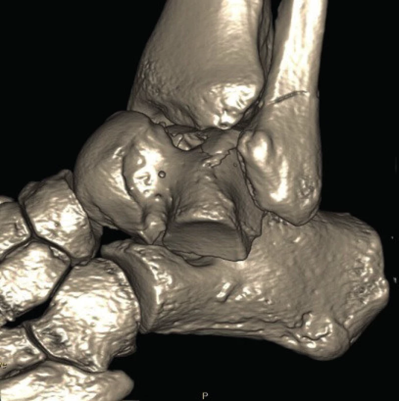Three-dimensional CT reconstruction of the ankle