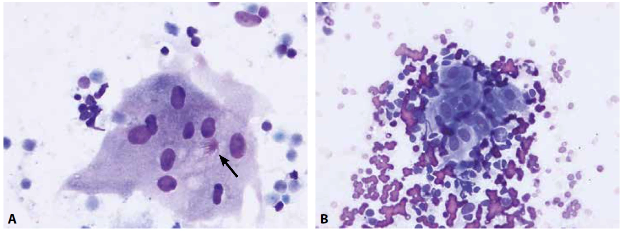 Granulomatózní proces je cytologicky charakterizovaný nálezem epiteloidních buněk a případně buněk obrovských mnohojaderných.<br>
A – obrovská mnohojaderná buňka s asteroidní inkluzí (šipka) u pacienta se sarkoidózou (nátěr z EBUS-FNA nitrohrudní lymfatické uzliny, Diff-Quik®, 400x)<br>
B – epiteloidní buňky, vyskytující se ve shlucích mezi buňkami uzliny, mají protáhlý tvar jader, jemný chromatin a bohatou, nezřetelně ohraničenou cytoplazmu
(nátěr z EBUS-FNA lymfatické uzliny u pacienta se sarkoidózou; Diff-Quik®, 400x)