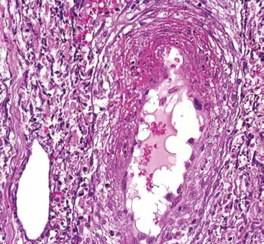 <b>Vaskulitida v kožní biopsii. </b>Céva vlevo dole je normální. Céva uprostřed má fibrinoidní nekrózu v horní části snímku, část endotelu se „postavila“ napříč a vyčnívá do lumen (barvení HE s elastikou).