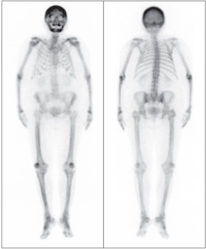 Na celotělovém snímku skeletu v únoru 2020 je
zobrazena difuzně zvýšená akumulace radiofarmaka
v lebce, dále je patrno prohnutí dlouhých kostí končetin,
především femurů. Na snímku jsou jen lehce naznačeny
ledviny