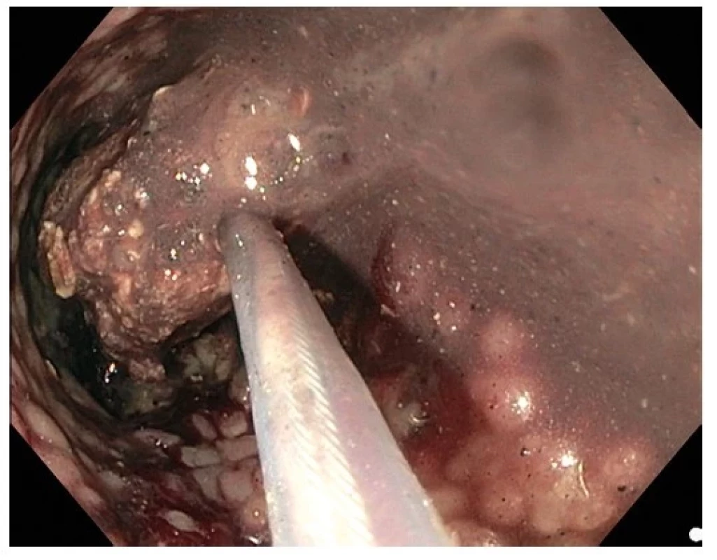 Endoskopická nekrektomie po transgastrické drenáži a zpřístupnění
ohraničené pankreatické nekrózy lumen-apozičním stentem, patrná
nekrotická hmota uchopená kličkou a stěna dutiny tvořená granulační tkání