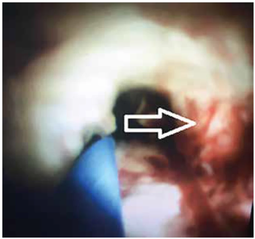 Cholangioskopie – ulcerující typ tumoru s patologickou
vaskularizací. Označeno šipkou.<br>
Fig. 4. Cholangioscopy – ulcerous type of tumour with
pathological vascularisation. Marked with the arrow