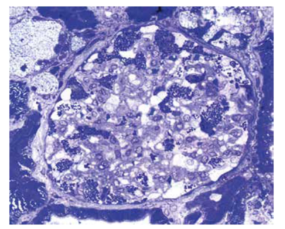 Polotenký řez glomerulu identifikuje okrouhlé inkluze v podocytech.
Morfologie je vysoce suspektní z Fabryho choroby (toluidinová modř, objektiv
40x).