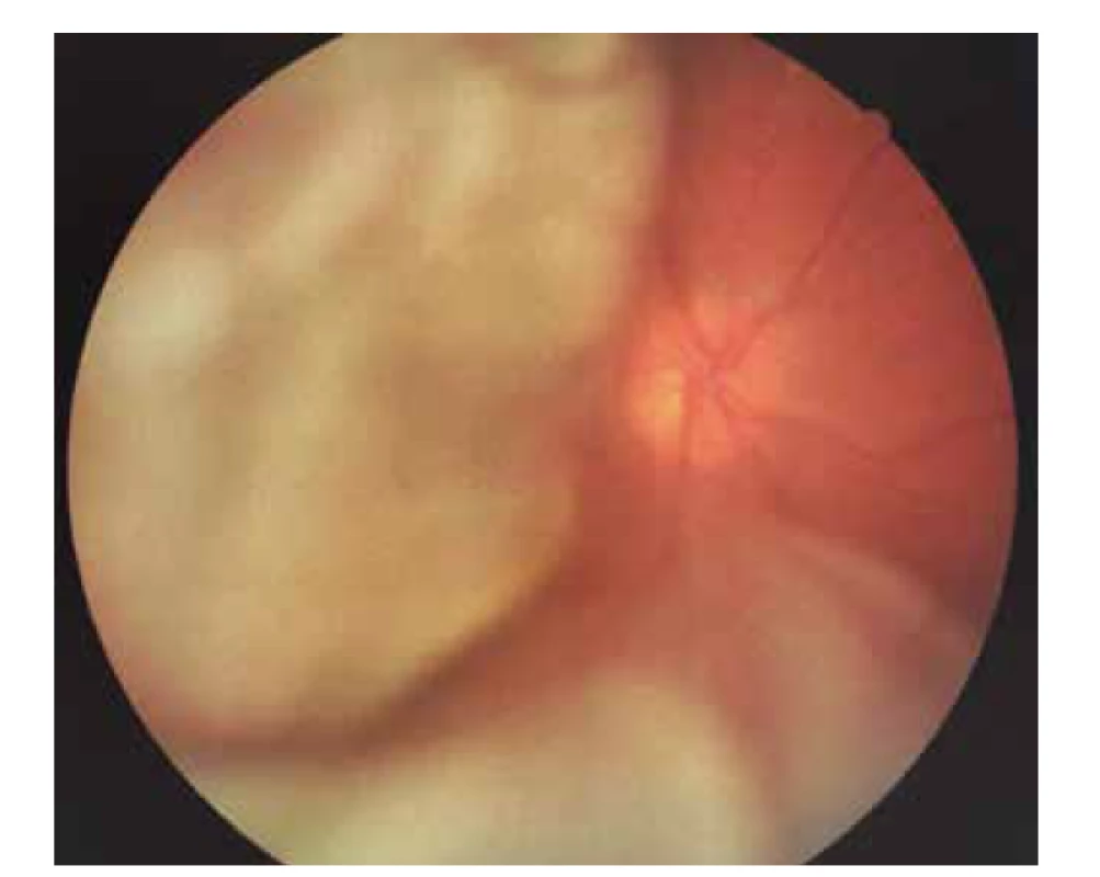 Foto očního pozadí pravého oka – papila bledší, ohraničená,
lehce temporálně prominující, mezi 7-11. hodinou tumorózní
masa, dole sekundární amoce, v periferii horního nasálního
kvadrantu sítnice leží
