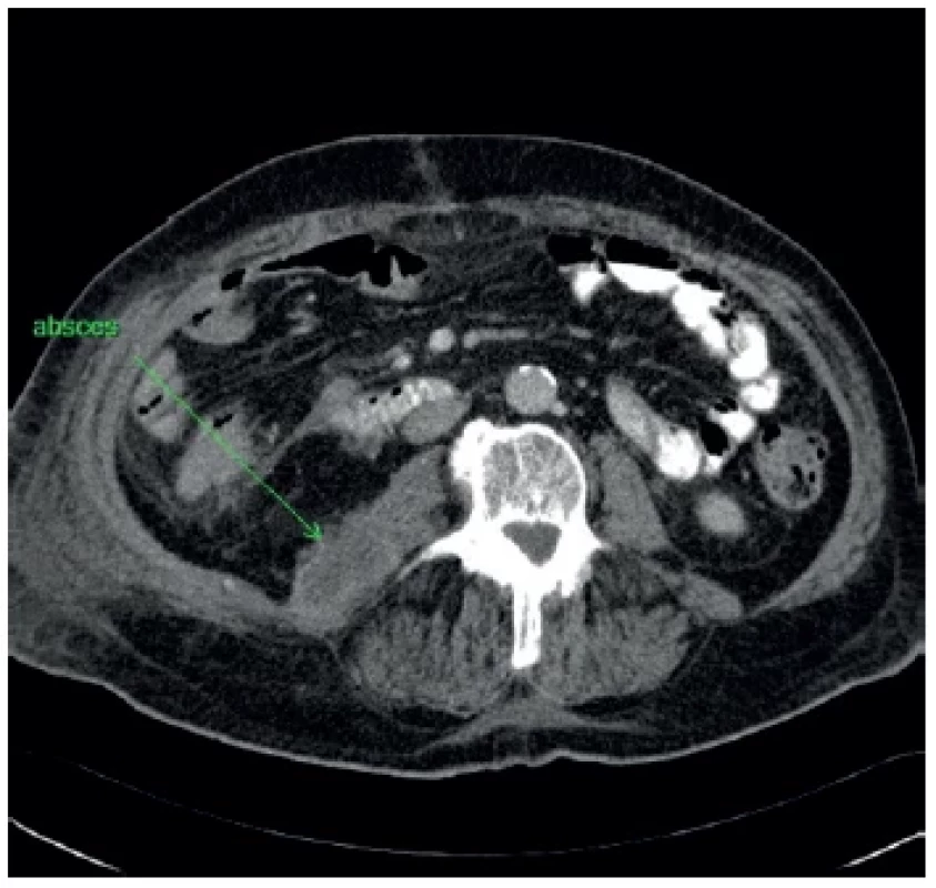 Vzťah abscesu k orgánom brušnej dutiny, nie je
jasné intra- alebo extraperitoneálne uloženie <br> 
Fig. 1. The relationship of the abscess to the abdominal
organs with difficulty to distinguish its intra- or extraperitoneal
location