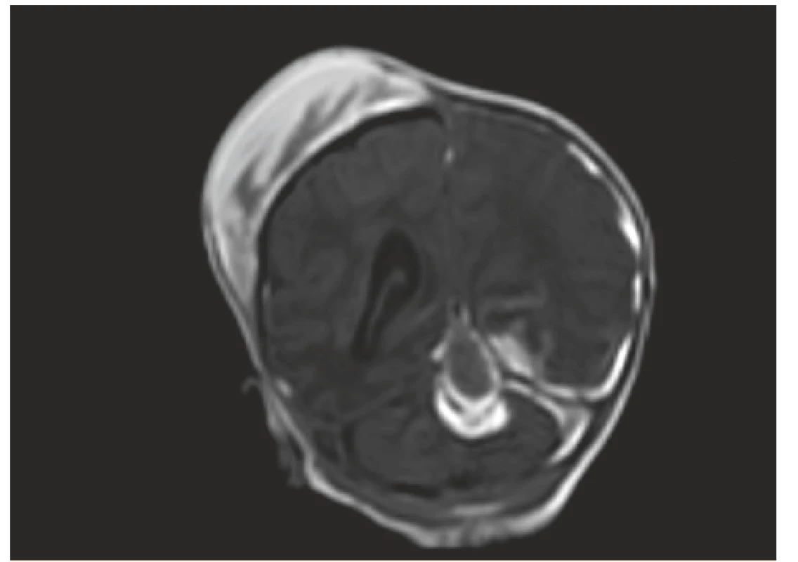 MR vyšetření, koronární řez – stejný pacient jako na
obr. č. 3 a 4, odstup 7 dní: V obrazech T1W FFE SENSE
jsou patrné subakutní subdurální hematomy podél
tentoria a levé mozkové hemisféry, dále hematom
mediálně v zadní jámě, nově rozvíjející se ischemické
změny T-P-O vlevo. Velikost kefalhematomu nyní lehce
zmenšena.<br>
Fig. 5. MR scan, coronal view – the same patient as No. 3 and
4 – interval 7 days: T1 FFE SENSE signal intensity are
indicative of left sided subacute subdural hematoma,
intracerebellar hemorrhage, newly developing left
T-P-O ischemic changes.
