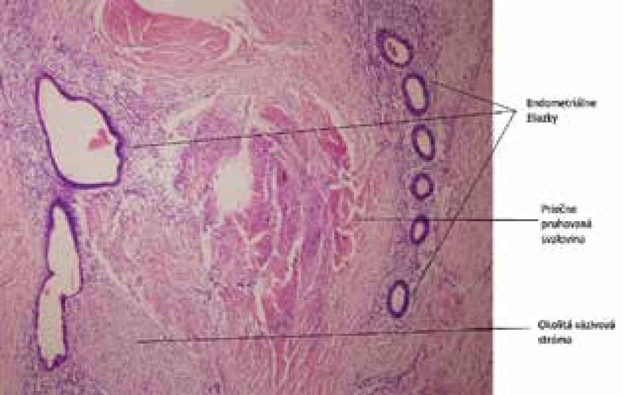 Endometrióza v jazve: prítomné je husté kolagénové väzivo, svalové vlákna a endometriálne žliazky. Farbenie Hematoxylín-eozín 40×<br>
Fig. 6: Abdominal wall endometriosis: collagen tissue, 
muscle fibres and endometrial glands, HE 40×