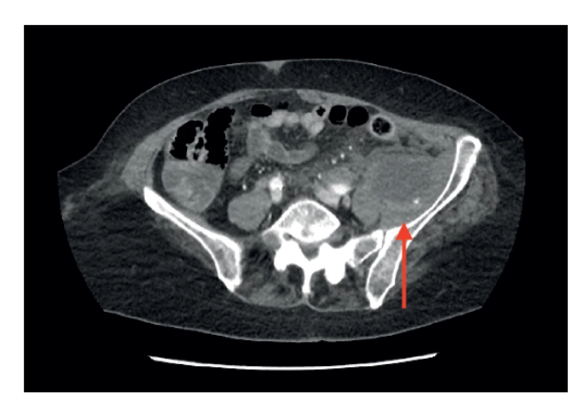 Pacientka 1, CT vyšetření ve venózní fázi, objemný
hematom levého retroperitonea zvýrazněn šipkou<br>
Fig. 1: Patient 1, venous phase CT, large hematoma in the
left retroperitoneum (arrow)
