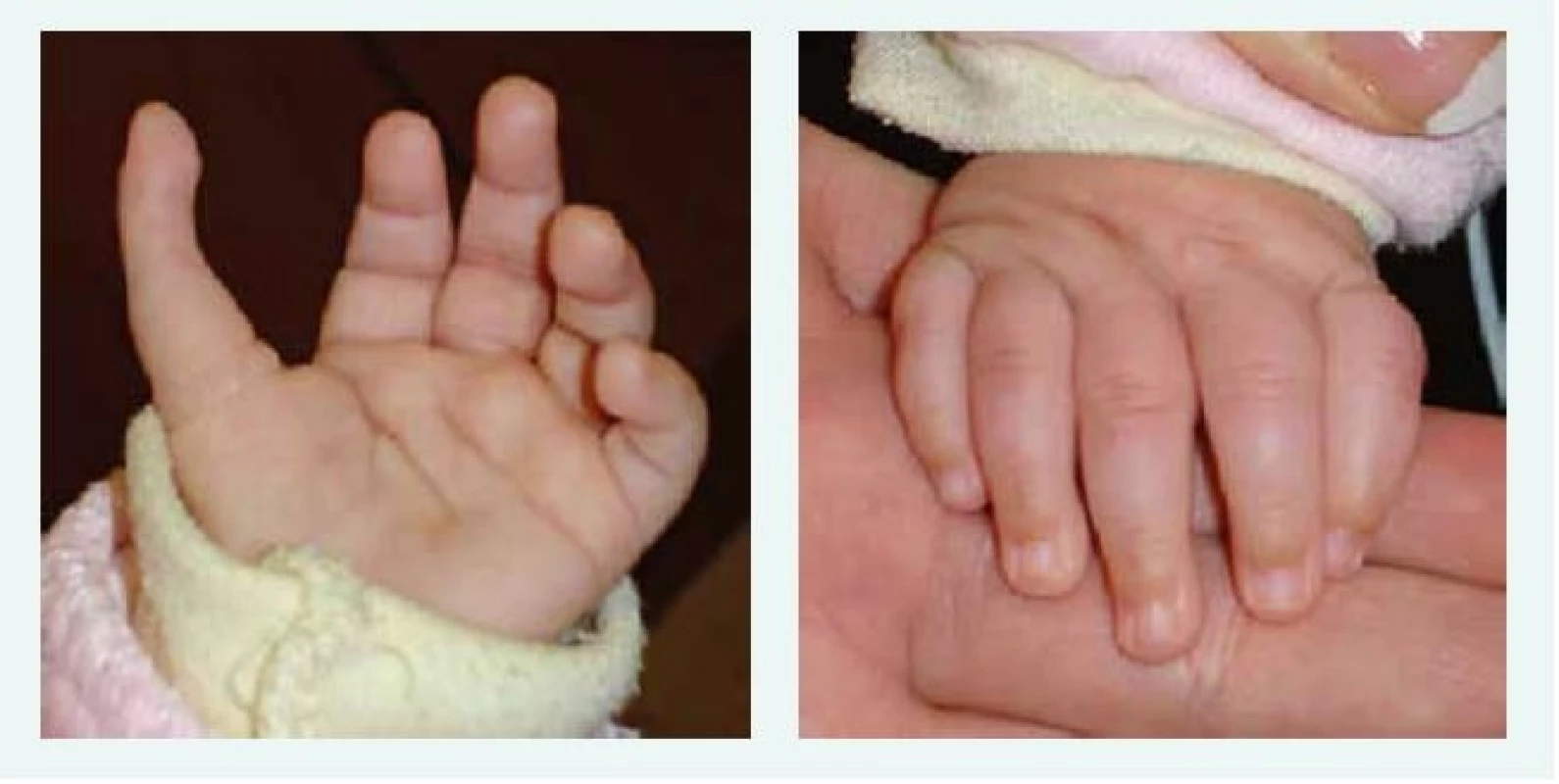 Tříčlánkový palec u kojence s Diamondovou-Blackfanovou anémií. Kromě tříčlánkového palce je patrný
i jeho atypický odstup. Anomálie si vyžádala plastickou operaci.