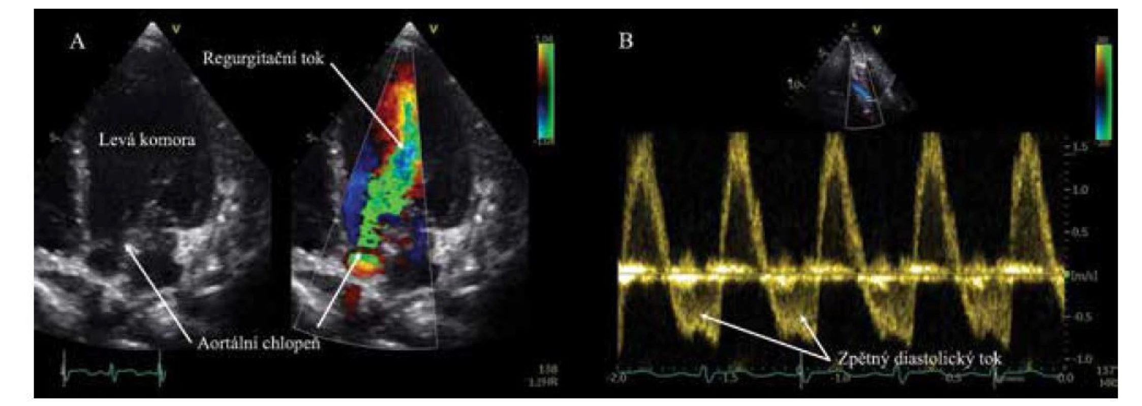 Echokardiografické vyšetření. A: Masivní aortální regurgitace v barevném dopplerovském mapování.
B: Pulzní dopplerovský záznam toku v břišní aortě s významným zpětným diastolickým tokem při významné
aortální regurgitaci.<br>
Fig. 1. Echocardiography. A: Massive aortic regurgitation in colour Doppler flow mapping. B: Abdominal aortic flow
in pulsed Doppler showing significant diastolic reverse flow due to massive aortic regurgitation.