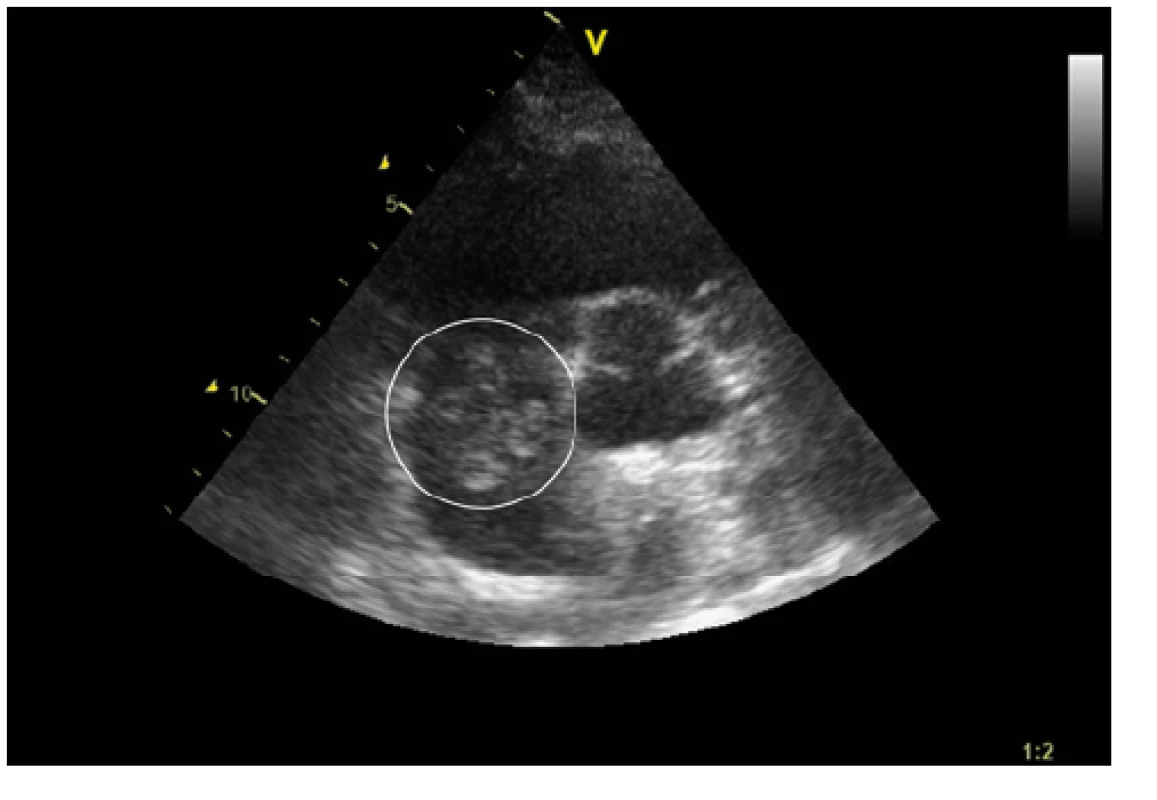 Vstupní transthorakální echokardiografie, parasternální projekce
na krátkou osu (PSAX): hyperechogenní útvar v pravé síni (v kruhu)