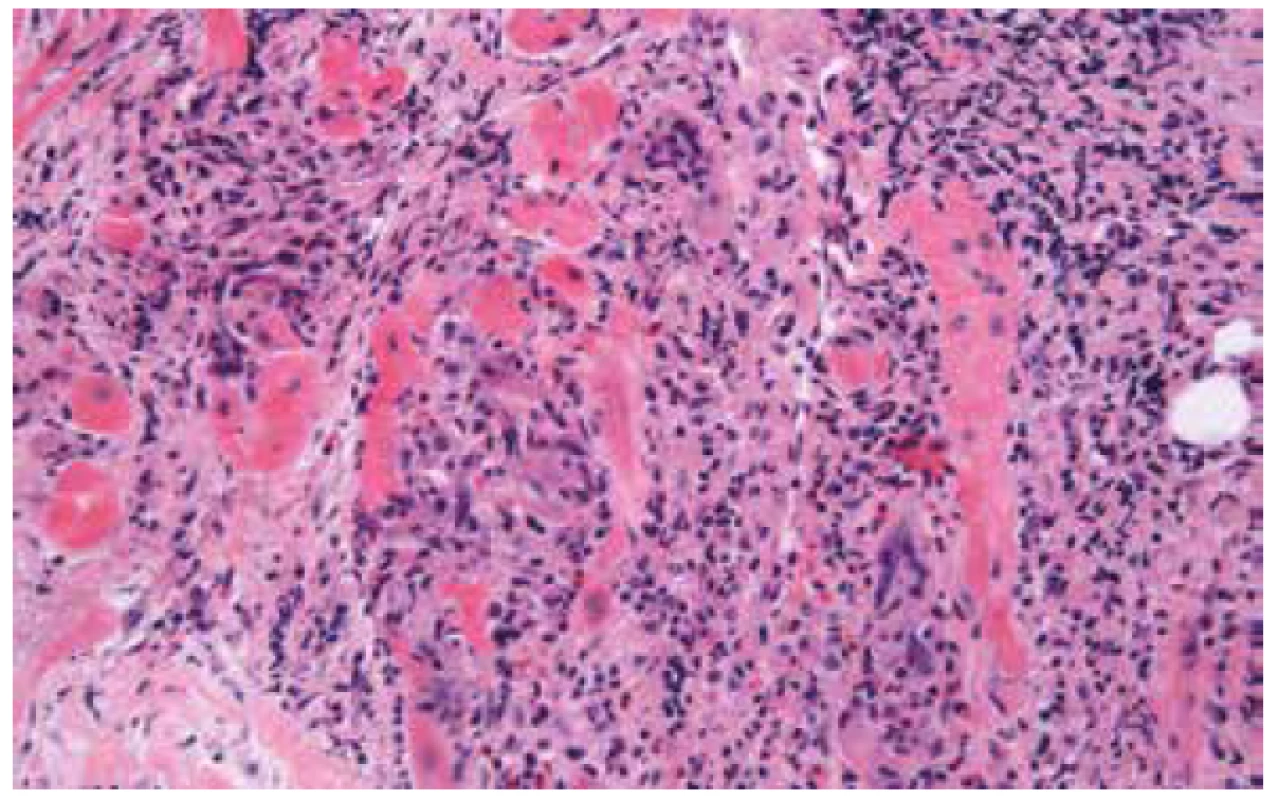 Obrovskobuněčná myokarditida s rozsáhlou destrukcí myokardu
a přítomností mnohojaderných buněk (hematoxylin & eozin, 200x).