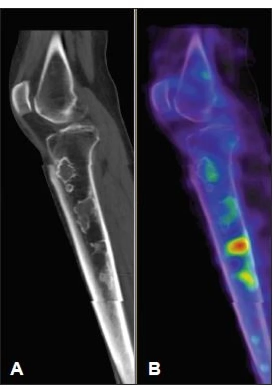 Low dose CT (A) a SPECT (B) obraz pravého kolena, sagitální řez. Je patrná nestejná metabolická reakce kosti v místě infarktu v závislosti na stadiu hojení.