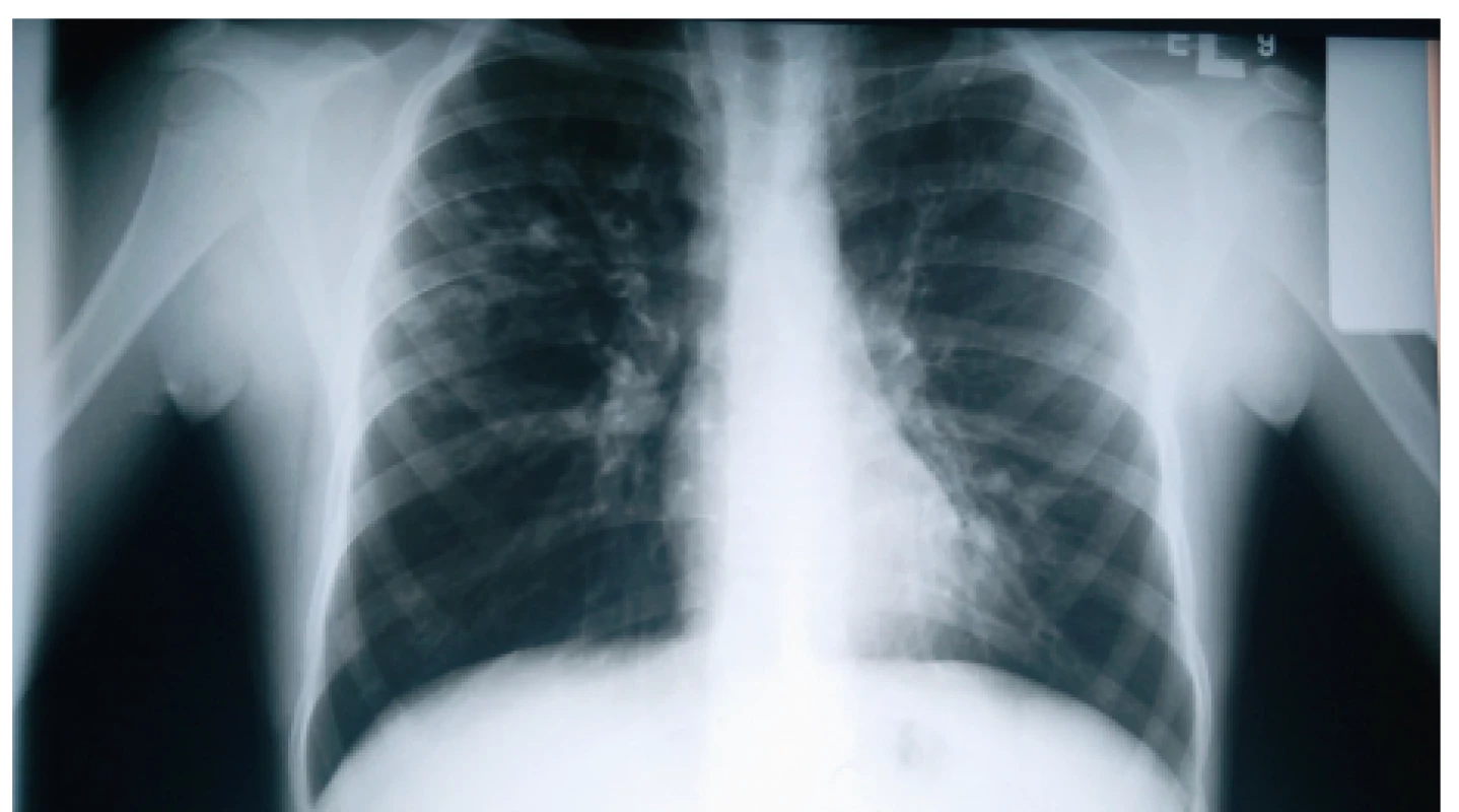 Bronchiektázie prítomné ako tzv. ring sign v pravom hornom
a strednom pľúcnom poli nášho pacienta (#004).<br>
Fig. 4. Bronchiectases presenting as ring sign in the right
upper and middle lung field in our patient (#004).