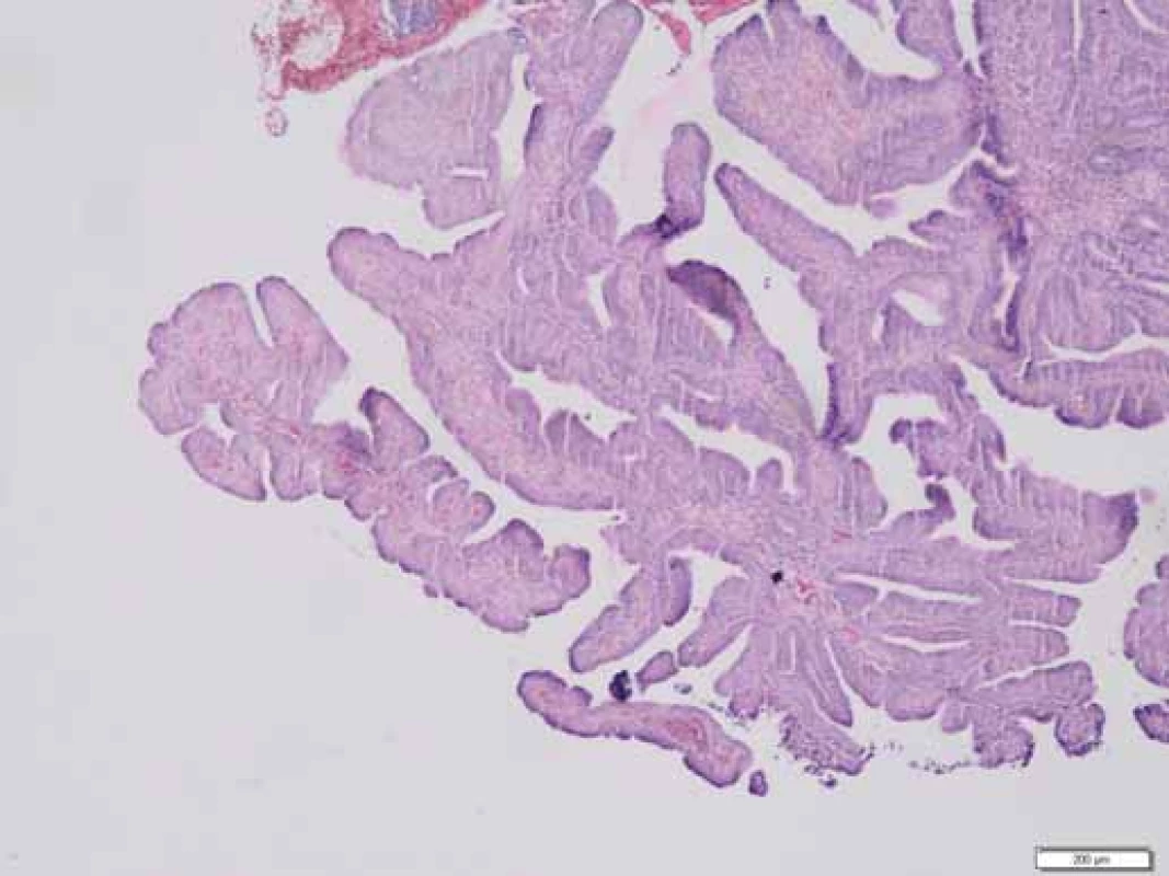 Histologie – polypózní adenomatózní léze. Zvětšeno:
40×.