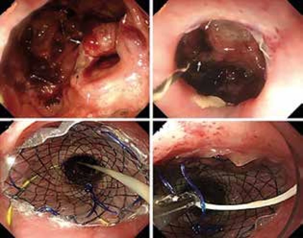 Použitie stentu v prípade dehiscencie anastomózy
(vlastný archív)<br>
Fig. 1: Use of stent in case of anastomosis dehiscence
(custom archive)