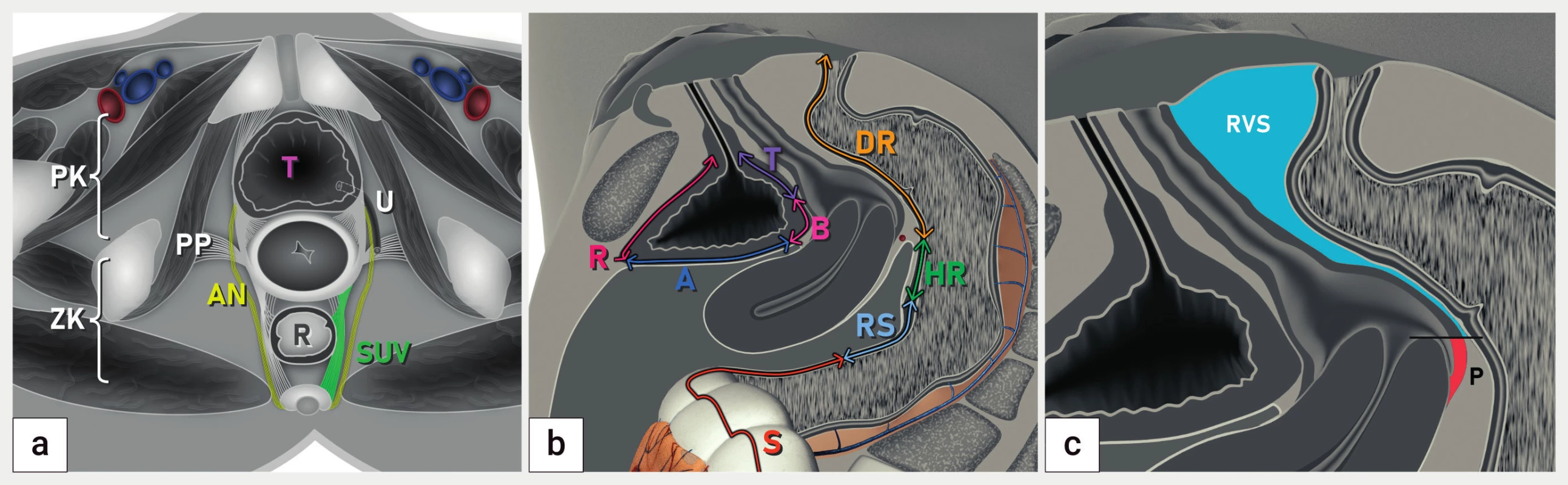 Lokalizace hluboké endometriózy podle doporučení IDEA<br>
Schéma koronárního řezu pánví (a), sagitálního řezu se zobrazením anatomických struktur močového měchýře a rekta (b) a sagitálního řezu
pánví se zobrazením zadní stěny pochvy a rektovaginálního septa
A – abdominální úsek močového měchýře (vertex), B – baze močového měchýře, DR – dolní rektum, HR – horní rektum, P – pochva, PK – přední
kompartment, PP – postranní parametria, R – retroperitoneální část močového měchýře, RS – rektosigmoideum, RVS – rektovaginální septum,
S – sigmoideum, SUV – sakrouterinní vazy, T – trigonum močového měchýře, U – ureter; ZK – zadní kompartment