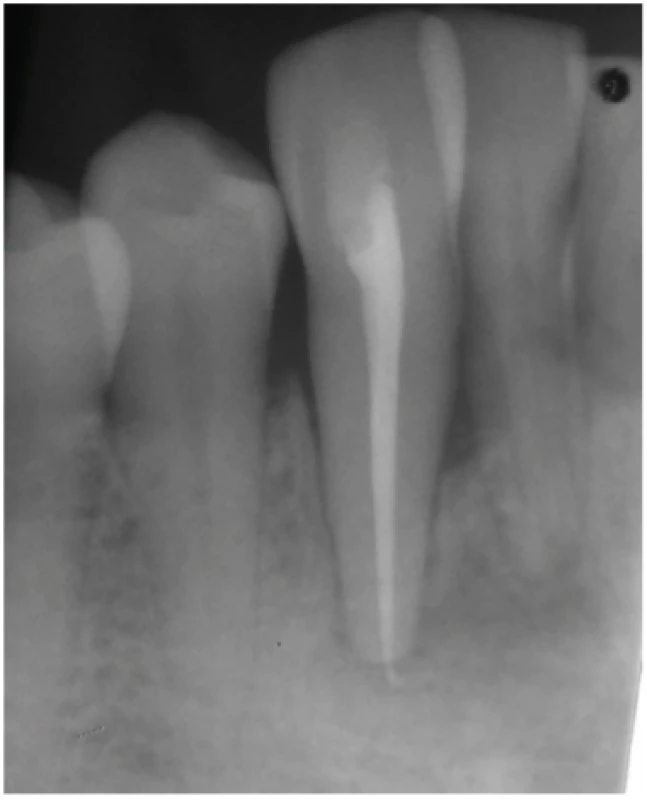 Check-up radiograph after 6 months
