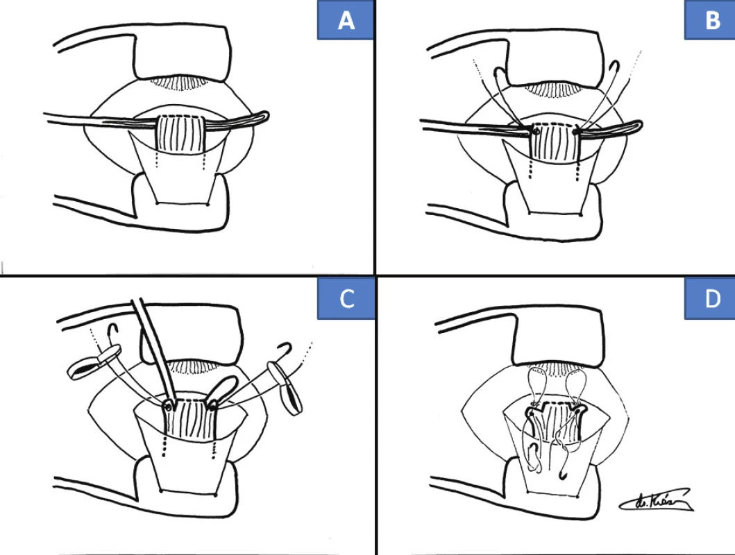 Cul-de-sac surgical technique: insertion of Daviel spoon (A), insertion of sutures made of Ethibond 5-0 (B), cutting off of muscle with sutures in close proximity to sclera (C), back stitching into original tendon (D)