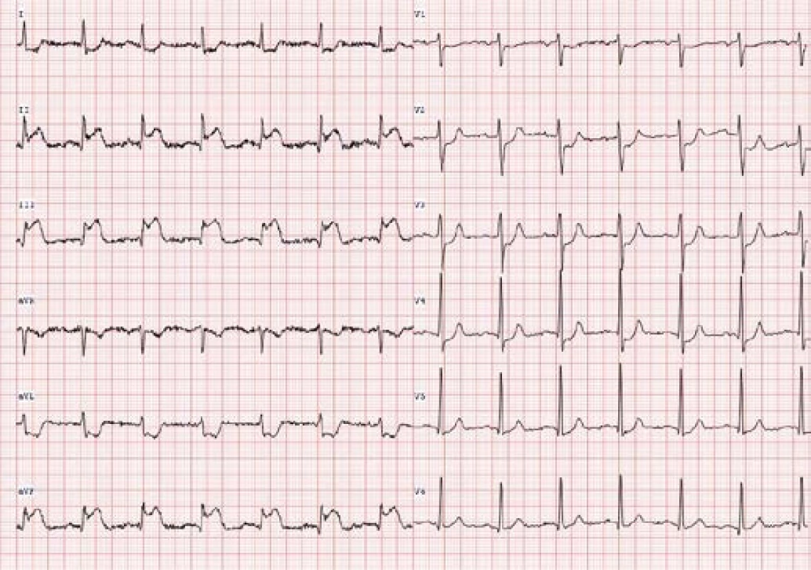 EKG při přijetí pacienta
