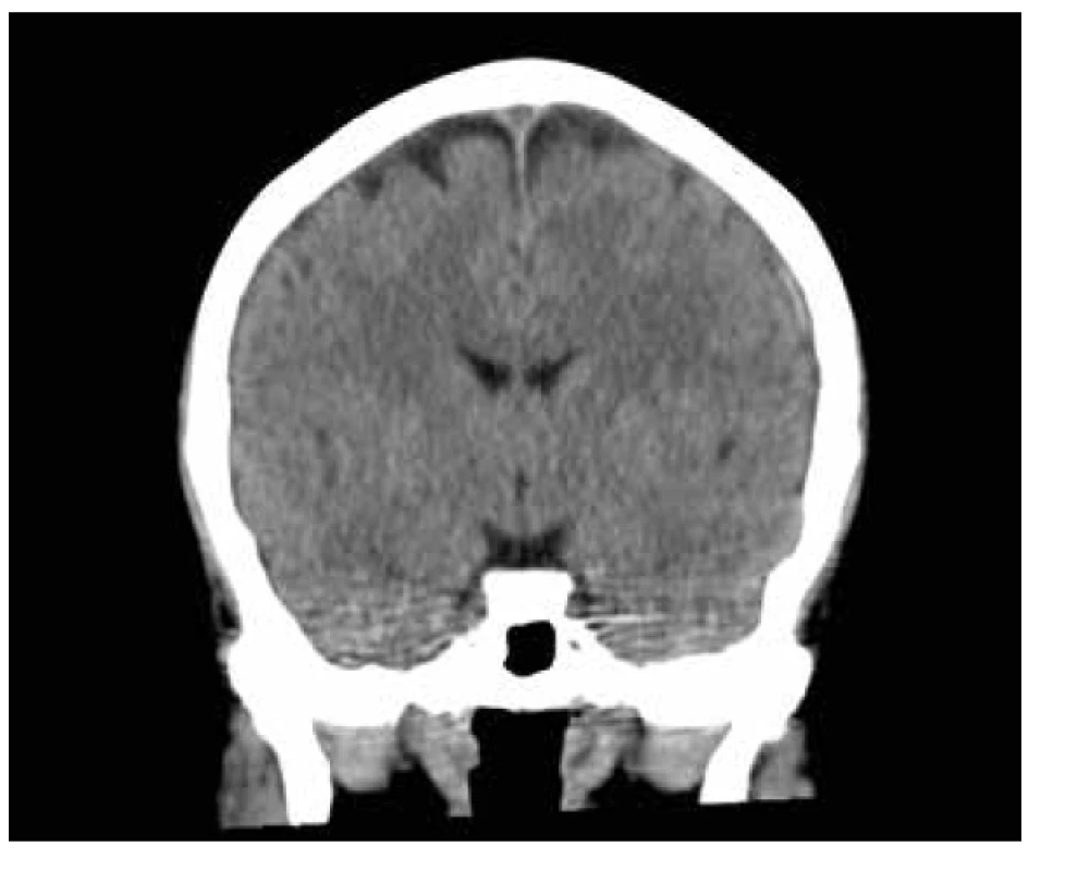 CT hlavy, frontální řez