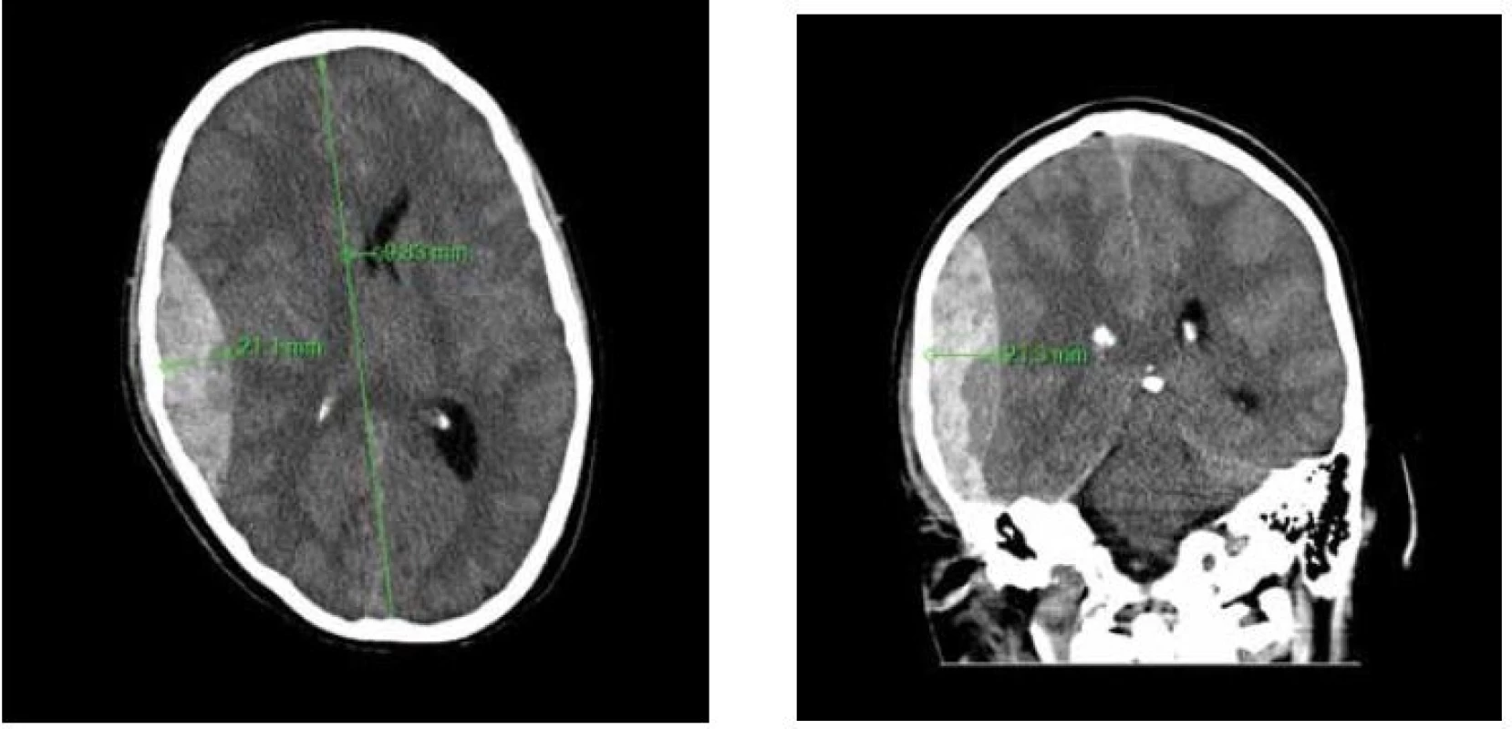 A,B: Nativní CT snímek mozku, axiální řez a koronární řez
Na pravé straně je zachycen fronto-parieto-temporální EDH s typickým bikonvexním tvarem. Šíře hematomu i posun
středočárových struktur jsou jasnou indikací k chirurgické evakuaci hematomu.<br>
Fig. 1 A,B: CT images of a patient’s brain demonstrating fronto-parieto-temporal EDH on axial and coronal image
The typical biconvex shape of EDH is well demonstrated. The width of EDH and midline shift are considerable.