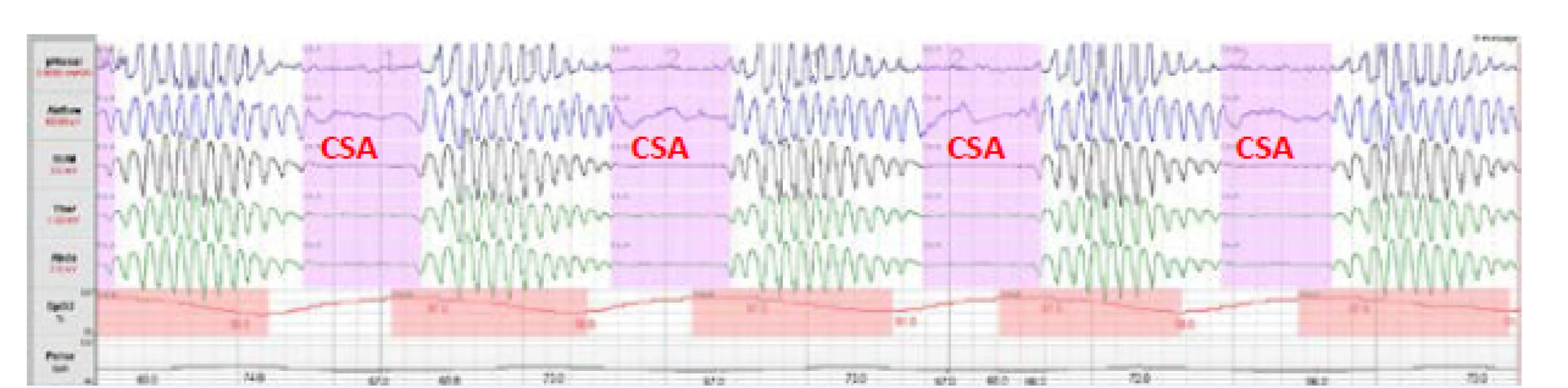 Centrální spánková apnoe (CSA)