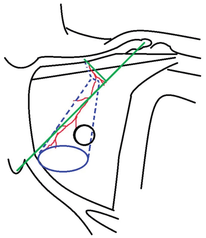 Preoperative planning: green color - the line from the
shoulder tip to xiphoid and its perpendicular from middle of
the clavicle showing expected position of pectoral branches of
thoracoacromial artery; blue color – skin island design; dashed
blue line – muscle dissection design