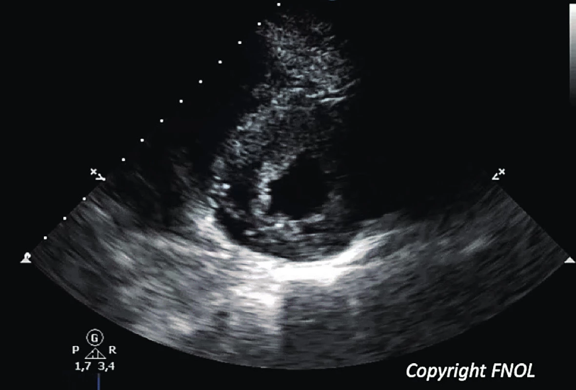 Echokardiografický obraz u 13leté pacientky s koncentrickou formou HKMP (parasternální krátký řez levou komorou).<br>
Fig. 3. Echocardiographic 2D scan showing an concentric form of hypertrophic cardiomyopathy in a 13yr old girl; parasternal short view.