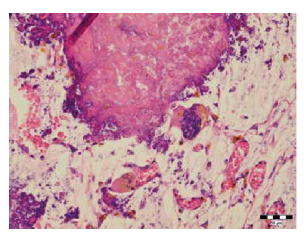Mnohojadrové bunky charakteru osteoklastov v okolí prasknutého
Meckelovho divertikula (hematoxylín-eozín, zväčšenie 400x).