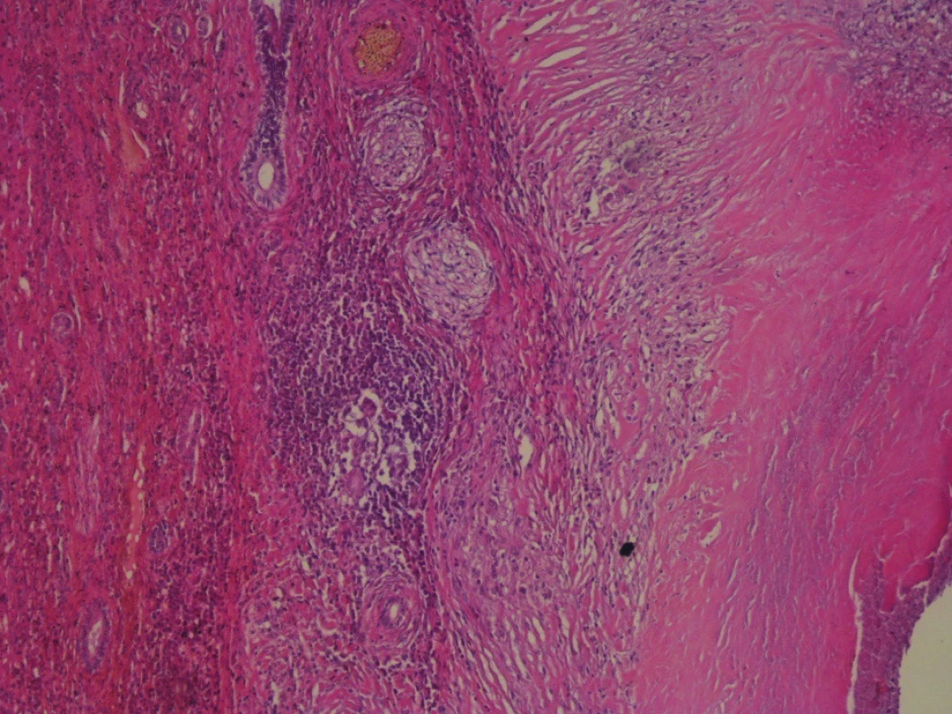 Histopatologické vyšetrenie
Ložisko kazeóznej nekrózy. Na periférii v epiteloidnom leme
sú prítomné mnohojadrové bunky Langhansovho typu (zväčšenie
20x, farbenie hematoxylínom a eozínom).<br>
Fig. 8: Hematoxylin Eozin stain
Bearing of caseous necrosis with giant cells of the Langhans
type are present on the periphery of the epitheloid limb (enlargement
20x).