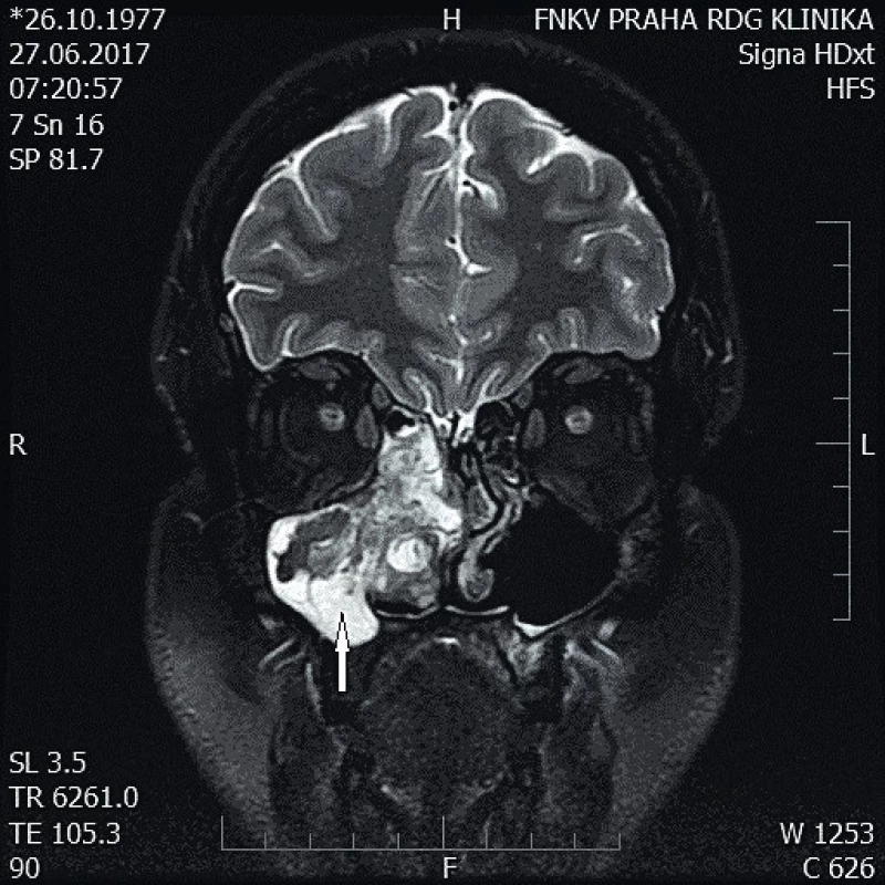 MR zobrazení pacienta s IP inzerujícím na rozhraní
mediální a dolní stěny orbity (viz také obr. 2b). Vlastní tumor jeví
CCP charakteristický obraz, bazálně v maxilárním sinu jsou patrné
odlišitelné sekundární zánětlivé změny (šipka).