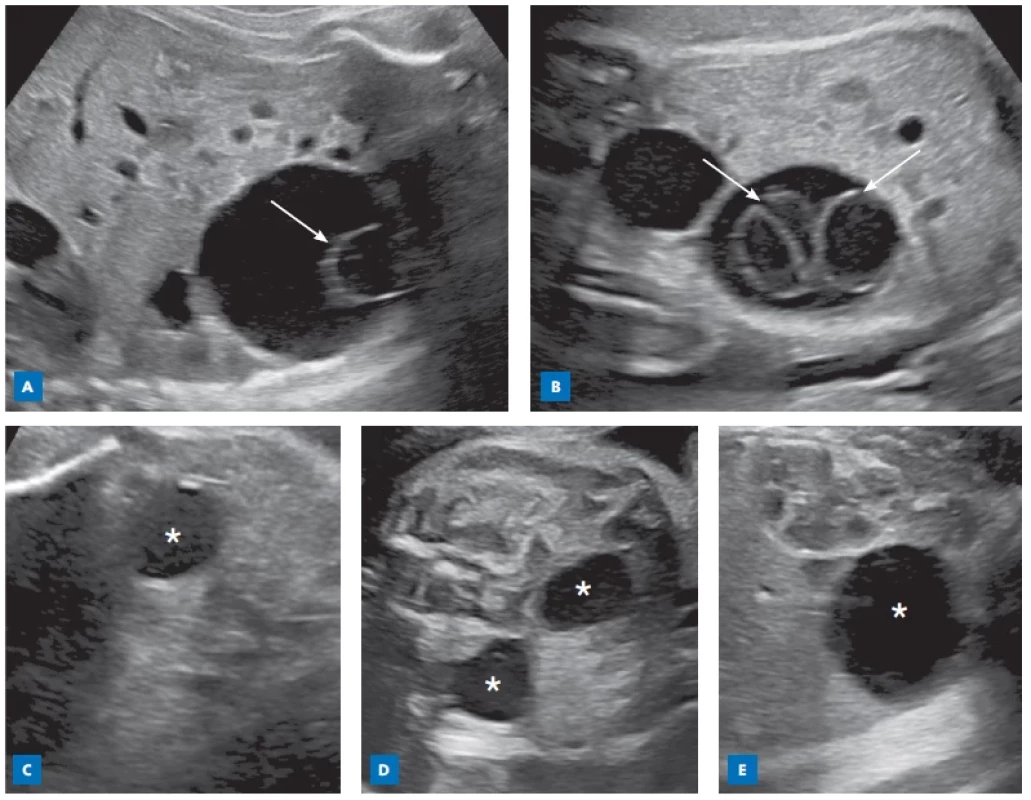 Prenatální ultrazvuk zobrazující jednoduché cysty u případů 1–5, u případu 1 (1a) a 2 (1b) s dceřinými cystami uvnitř lumen (šipky),
u případů 3–5 (1c–1e) s anechogenním obsahem (hvězdy)