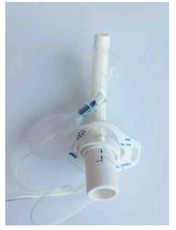 Dvouplášťová kanyla s manžetou.<br>
Fig. 1. Double plastic tracheostomy tube with a cuff.