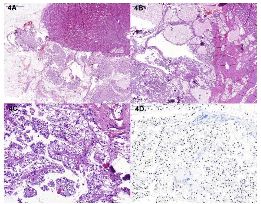 Histologický nález; A – přehledové zvětšení, B – detail cystického uspořádání tumoru, fokálně se solidnější
mi okrsky, přítomny jsou výrazné kalcifikace, C – papilární struktury, lemovány buňkami se světlou cytoplazmou,
D – imunohistochemický průkaz TFE3<br>
Fig. 4. Histological finding; A – overview, B – detail, cystic appearance of the tumor, focally with initially solid
areas and calcifications, C – typical papillary structures, lined by cells with clear cytoplasm, D – TFE3 immunohistochemistry
(nuclear positivity)