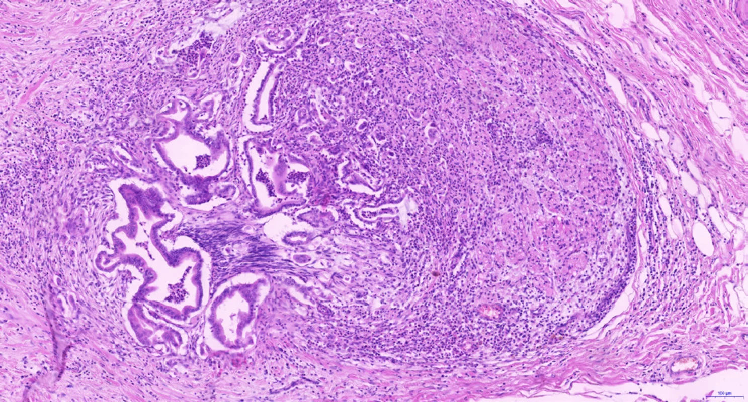 Perineurální šíření cholangiocelulárního karcinomu. Adenokarcinomové žlázky rozsáhle vrůstají do větve nemyelinizovaného periferního nervu v jaterním hilu. Histologický řez z chirurgického resekátu, hematoxylin-eozin, 10×.