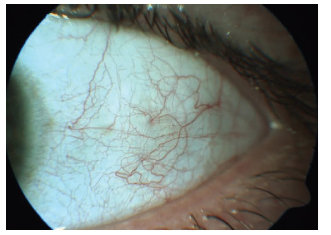 HIV mikrovaskulopatie na předním segmentu oka – tortuozita
cév, přerušovaný krevní sloupec, mikroaneurysmata