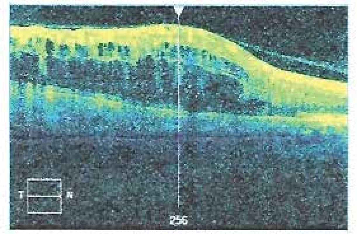 Image of optical coherence tomography in the
same patient obtained upon indication for intravitreal
treatment with ranibizumab, central retinal thickness 759
μm, macrocystic edema in the region of the upper 2/3 of
the central landscape